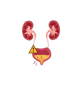 Kidney Stones